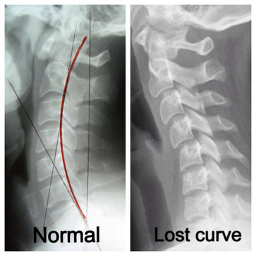 cervical x-ray normal and lost curve