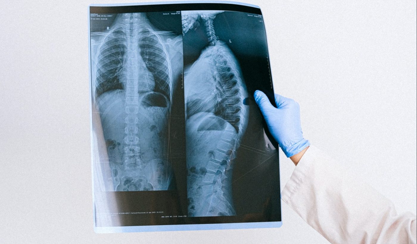 Spinal X-Ray
